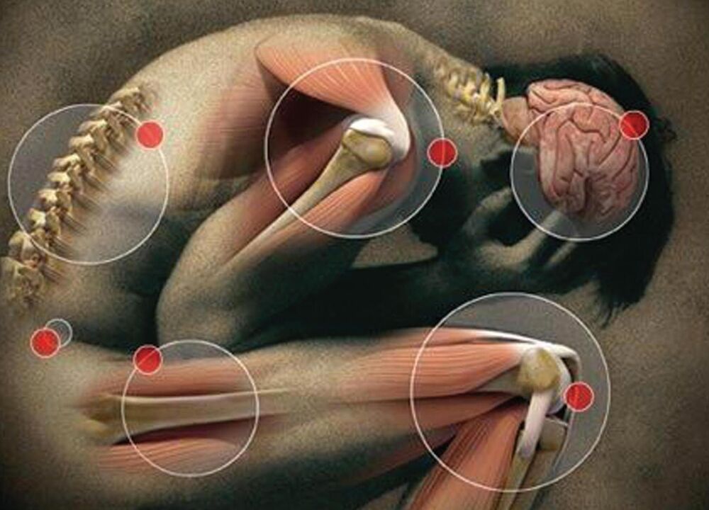 Articulacións do corpo afectadas pola artrose