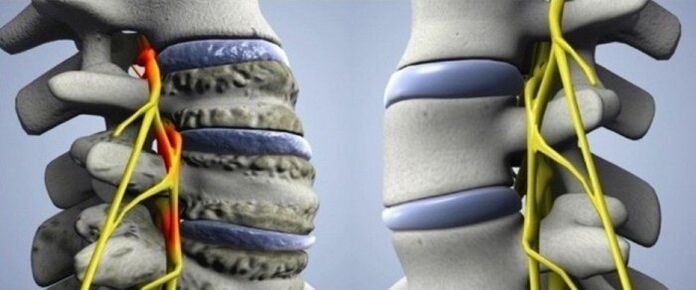 Columna vertebral san e afectada con artrose